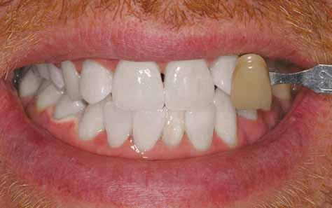 A strong bleaching solution will be applied to your teeth, leading to dramatic