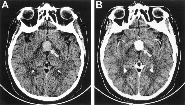A, Sagittal contrast-enhanced spin-echo MR image (500/15) of Patient 1, a 59-yearold man. Note hypothalamic involvement (arrows).