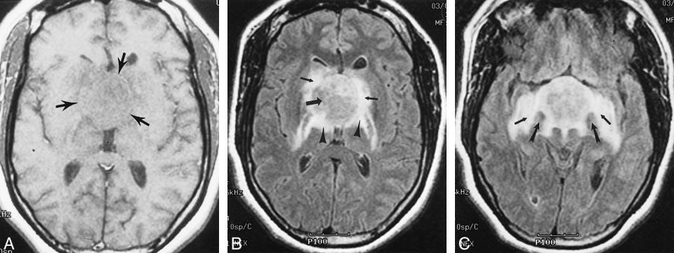 AJNR: 22, March 2001 CHORDOID GLIOMA 467 FIG 3. Images of Patient 5, a 35-year-old woman with chordoid glioma.