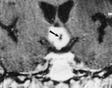 B, Axial fluid-attenuated inversion recovery MR image (8912/142; inversion time, 2200 ms) reveals an iso- to slightly hyperintense hypothalamic/third ventricular (large arrow).
