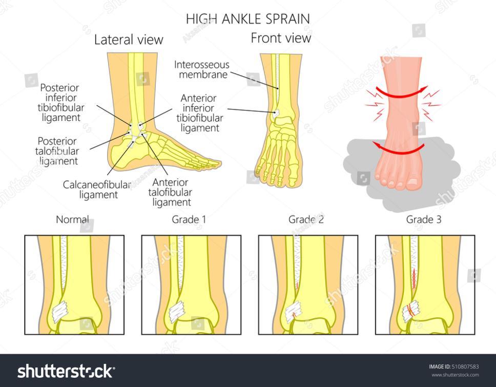 High Ankle Sprains Pain ABOVE the ankle Don t usually occur with lower ankle sprains Twisting injury AITFL,IOL,PITFL,Inferior transverse lig Pain with squeeze