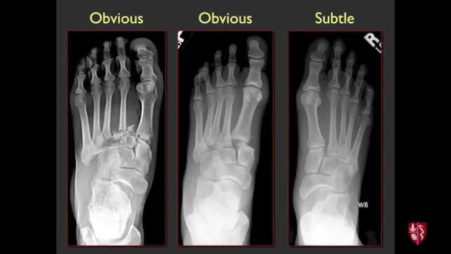 arch Metatarsals 1,2,3 should line up with their respective 1,2,3 cuneiform bones.