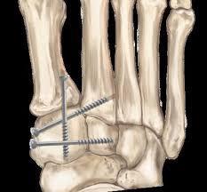 Recent advocates for FUSION of joints.