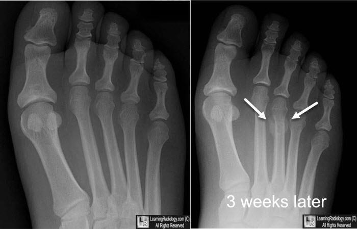 Often 2 nd MT (long and thin) Initial Xrays may be normal for 2-3 weeks Serial Xrays,Bone scans,mri C-128 tuning fork If suspect