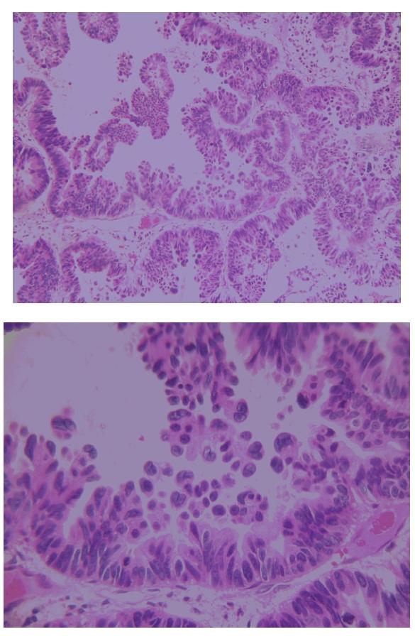 Base upon histologic pathology, well differentiated adenocarcinoma in the background of benign hyperplasia and adenoma was documented in all patients except one, who showed pure adenoma.