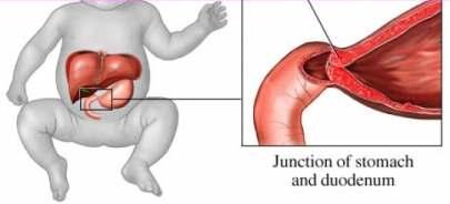 Pyloric stenosis occurs when the circular and, to a lesser degree, the longitudinal musculature of the stomach in the region of the pylorus
