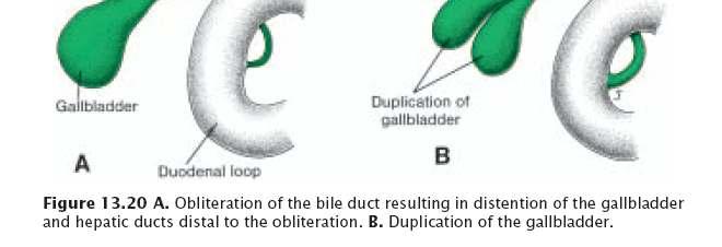 In some cases the ducts, which pass through a solid phase in their development, fail to recanalize This defect, extrahepatic biliary atresia, occurs in