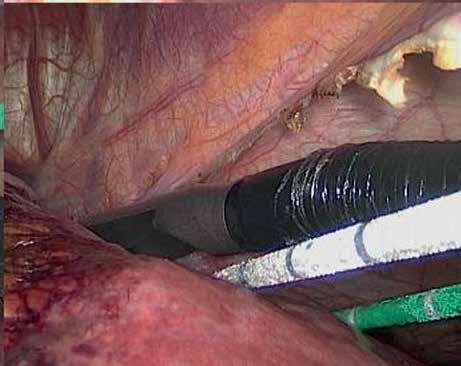 Among these cases, 2 additional tumors were discovered intraoperatively. Short-term data The postoperative complications included pain (n = 8), fever (n = 6), and abdominal distension (n = 6).