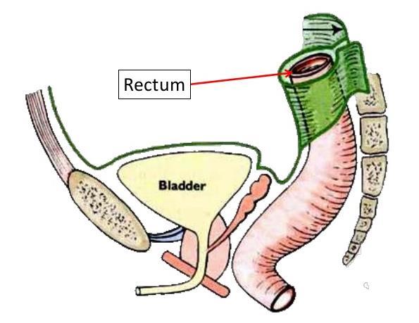 The pouches The peritoneum contains pouches, the pouch is a large fossa, clinically important because it may cause internal abdominal hernia and pus can accumulate in it.