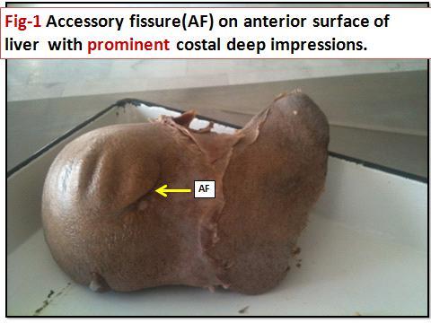 accessory liver sulci, absence of quadrate lobe and fissure for ligamentum teres, gall bladder fossa was broad shifted to left.