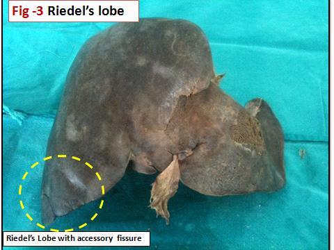 The present study had linguiform lobe of left lobe in two specimens(4%), hypotrophy left lobe in one specimen (2%), hypertrophy of left lobe with transverse saddle shape liver in two specimens(4%)&