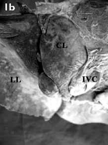 The inferior vena cava inclines to the left superior to the caudate lobe; (b) the papillary process separated from the caudate lobe by a fissure; (c) a narrow rectangular caudate lobe (held between