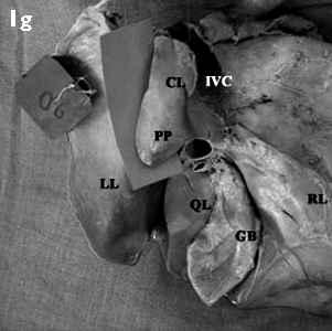 161 The major fissures are important landmarks for interpreting the lobar anatomy and locating the liver lesions.