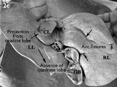In these cases, the fissure for ligamentum teres was in close proximity to the left margin of the gall bladder fossa (Fig. 2a). In another 20% of the livers, various other shapes were observed, viz.