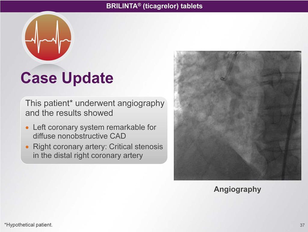 Talking Point The patient s angiography showed left coronary system remarkable for diffuse