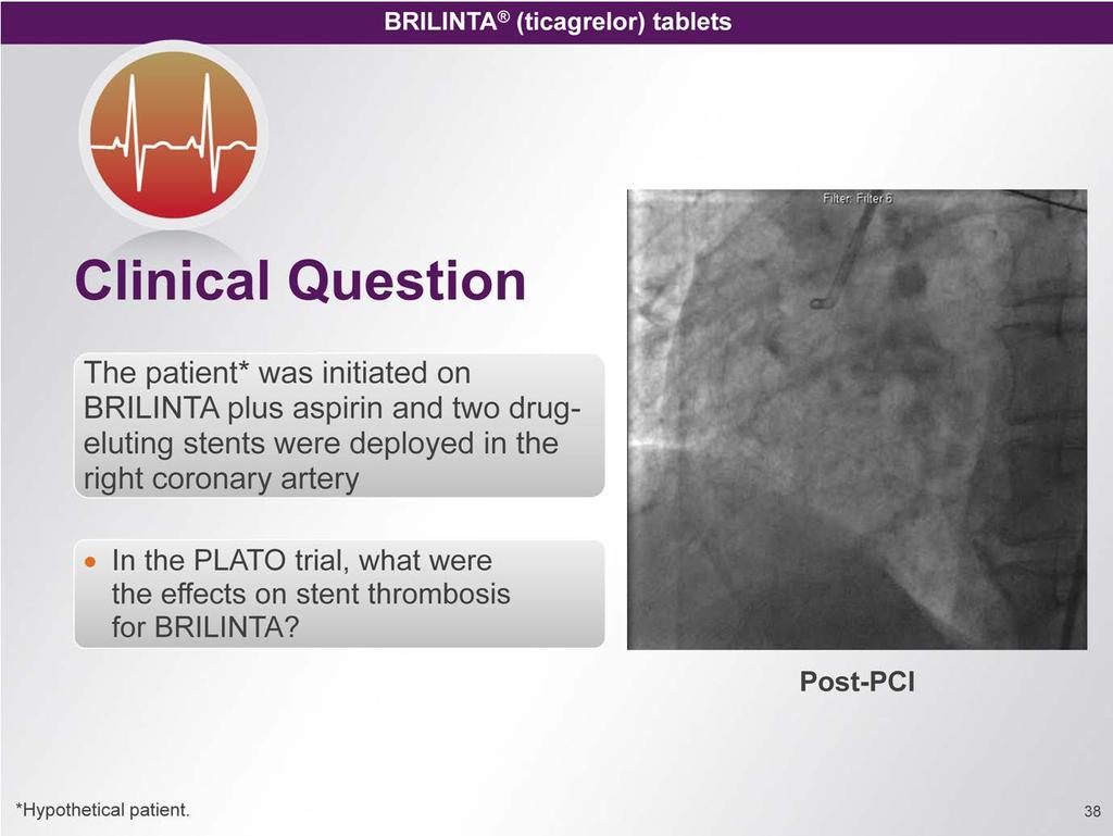 Talking Point BRILINTA plus aspirin was initiated and two drug-eluting stents were deployed in the right coronary artery Note to Speaker This is a rhetorical question.