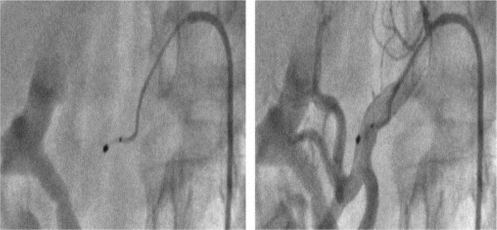 Renal Denervation for Hypertension Fluoroscopic Images of Catheter Positions in the Renal Artery Radiofrequency catheter positioned in the