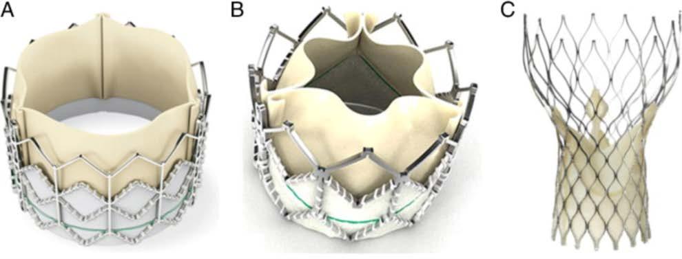 Current Status of Transcatheter Aortic Valve Replacement Current Widely Available Transcatheter Valves (A) The Edwards SAPIEN THV balloon-expandable valve (Edwards Lifesciences, Irvine, California)