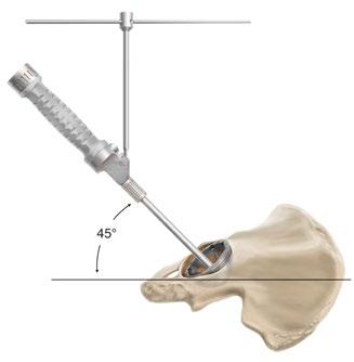 ACETABULAR CUP TRIALLING AND POSITIONING (2217-50-041 PINNACLE Straight Cup Impactor/2217-50-044 PINNACLE Version Guide) An alignment guide is provided to assist with cup positioning.