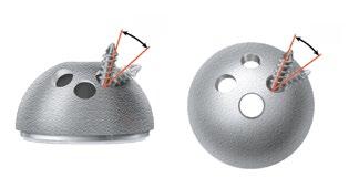 IMPLANTING THE ACETABULAR CUP WITH SCREW FIXATION Screw Insertion The PINNACLE Sector Cup has three screw holes and is designed for insertion with screws.