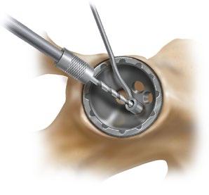 The single lateral screw provides additional access to the ilium. The drill bit is controlled by the drill guide as it passes through selected holes into the acetabulum (Figure 17).