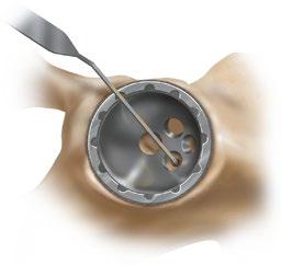 IMPLANTING THE ACETABULAR CUP WITH SCREW FIXATION Verify hole depth using the QUICKSET Depth Gauge.