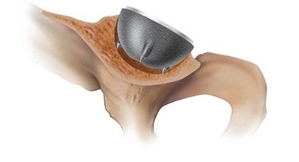 IMPLANTING THE ACETABULAR CUP WITH SPIKES PINNACLE 300 Series Cup Insertion Spikes placed along the radius of the PINNACLE 300 Series cup are coated and are for