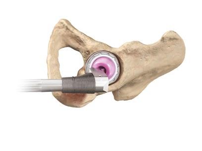 FUNCTIONAL ASSESSMENT Correct component placement is critical for the longevity of the hip reconstruction.