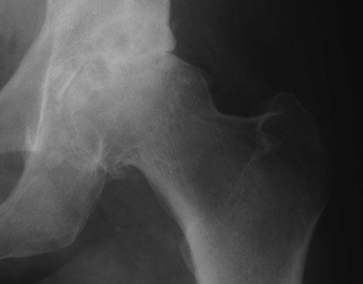 TEMPLATING AND PRE OPERATIVE PLANNING The radiographs should clearly demonstrate the acetabular configuration and the endosteal and periosteal contours of the femoral head, neck and proximal femur