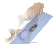 ACETABULAR CUP TRIALLING AND POSITIONING Determining the Abduction Angle The pre operative A/P X ray can help determine the ideal abduction angle (Figure 5) and be helpful in determining how much of