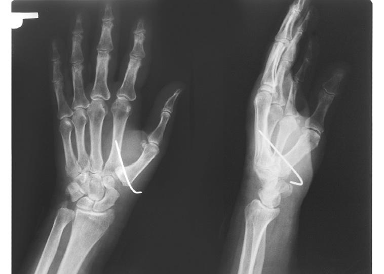 Swanson v roku 1968 ako prvý opísal silikónový implantát pre artritídu rôznych kĺbov v ruke, vrátane palca CMC kĺbu (13).