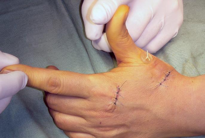 Jeho funkcia je extenzia palca, predovšetkým v interfalangeálnom kĺbe a spolupôsobí pri addukcii palca z krajnej abdukcie. Je inervovaný z ramus profundus n.