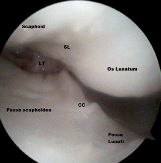 Obr. 4: Artroskopický pohľad vpravo z dorzálneho portu 3 4: na distálnom rádiu je medzi fossa scaphoidea fossa lunata jemná eminentia crista cartilaginosa (CC).