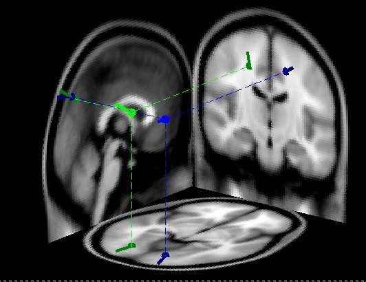 with distinct dynamics and scalp projection maps strongly resembling an equivalent current dipole a