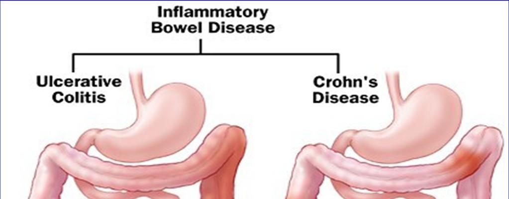 Inflammatory Bowel Disease (IBD): Two diseases of chronic inflammation of