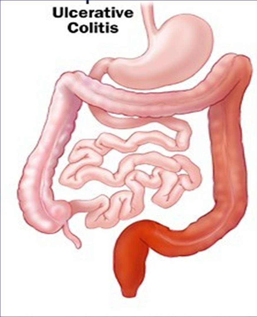 ULCERATIVE COLITIS (UC) Inflammation of the inside lining (mucosa) of the colon Chronic, lifelong disease though can be stopped by colectomy