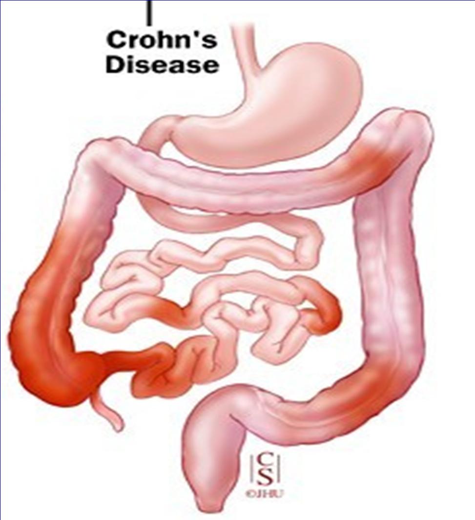 Crohn s Disease (CD) Inflammation of the all layers of primarily ileum and/or colon Chronic, lifelong disease tends to recur after surgery Affects about