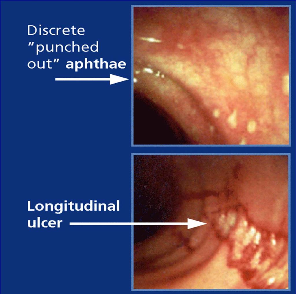 Crohn s Endoscopic Appearance Adapted from