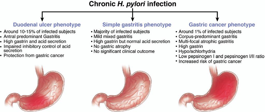 314 AMIEVA AND EL-OMAR Vol. 134, No. 1 Figure 2. Pathophysiologic and clinical outcomes of chronic H pylori infection.