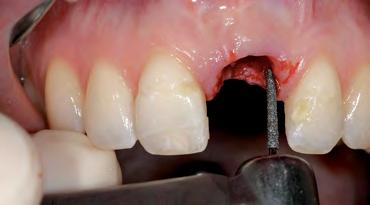 hard and soft-tissue volume after extraction in the anterior region for late implant placement.