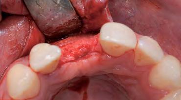 A slight buccal bone defect was observed. 2 The socket is gently curetted for removal of granulation tissue.