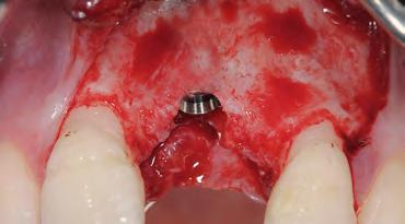 3 Filling of the extraction socket with Geistlich Bio-Oss Collagen to the level of the palatal bone.