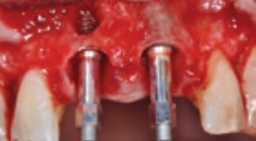 Achieve successful osseointegration and improved anterior esthetics for the central