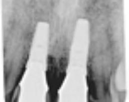 periapical radiograph. 3 Immediate implants in place.