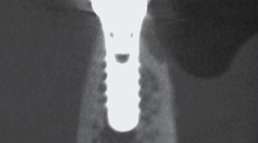 3 Buccal bone defect with dual-walled morphology.