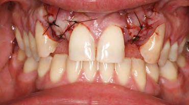 gingival height and presence of interdental papilla which needed to be preserved.