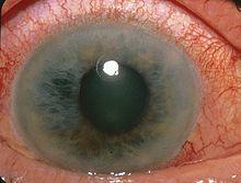 Causes in Patients Heredity Age Ocular trauma Ocular