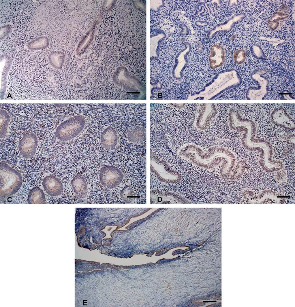 M.Ulukus et al. Figure 2. Representative micrographs of immunohistochemistry staining for CXCR2 in the eutopic and ectopic endometrium of women with and without endometriosis.