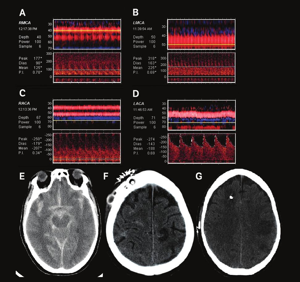 Case 2 A 56-year-old woman was admitted to the neurologic intensive care unit with extensive SAH in the basal cisterns (Figure 2, A C), and a diagnostic angiogram was unrevealing.