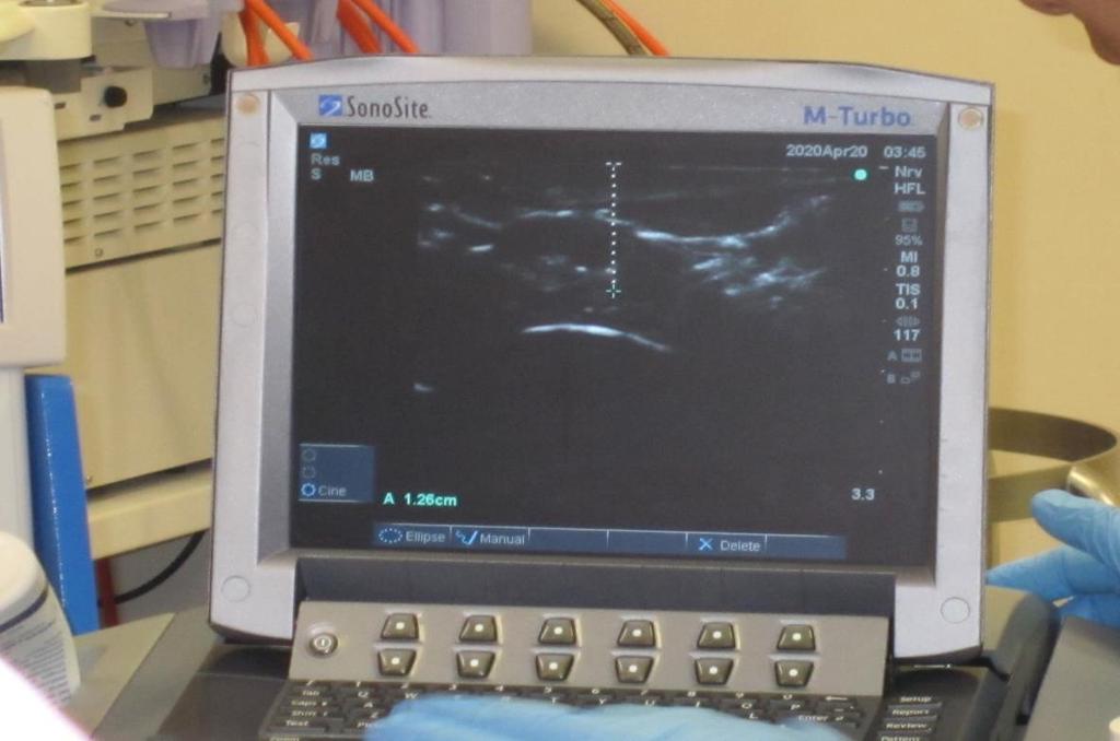 cavity Ultrasound